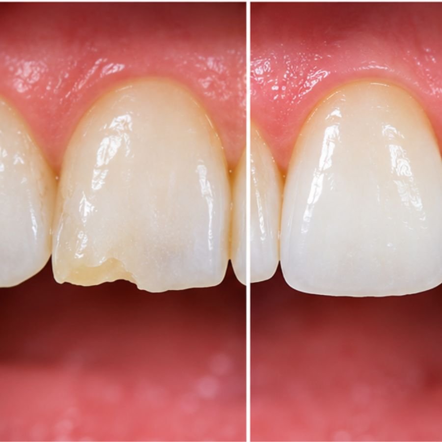 Bioclear Dental Treatment Langley