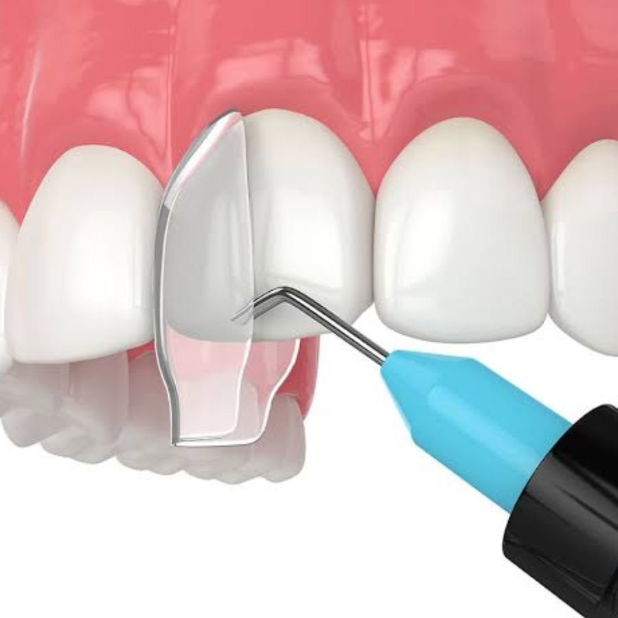 Composite Bonding Langley