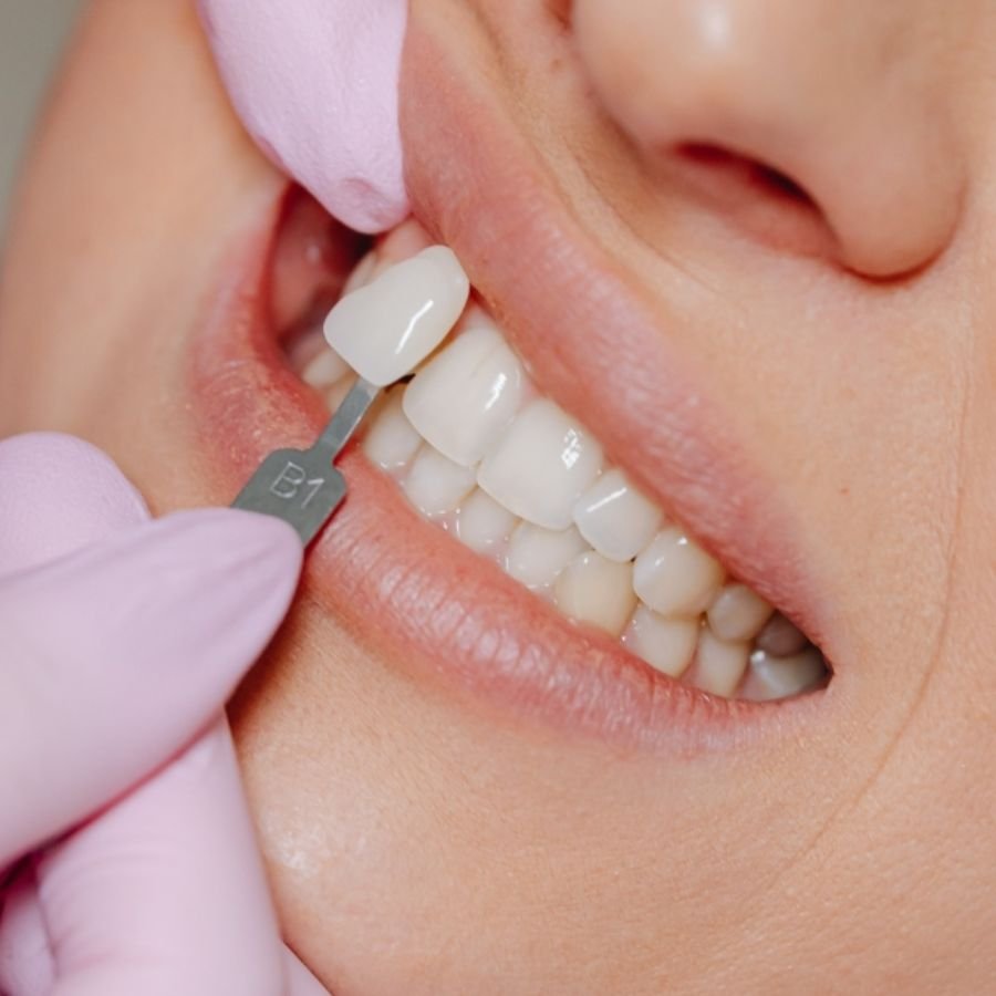 Composite Bonding Slough