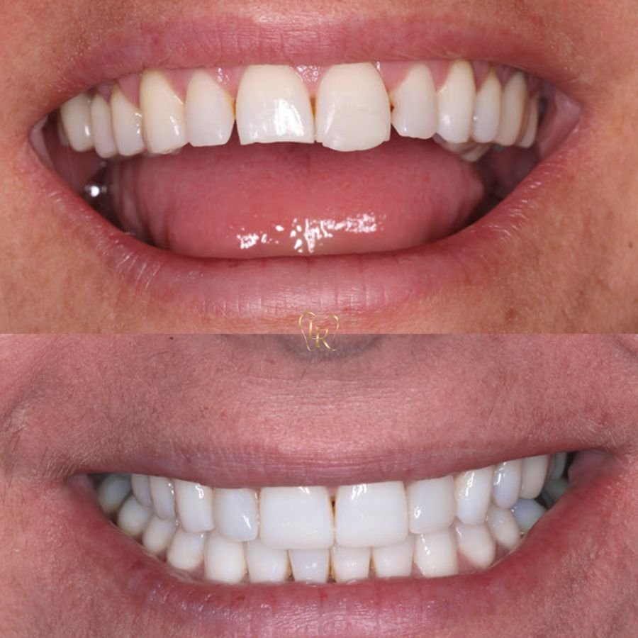 Composite Bonding in Langley