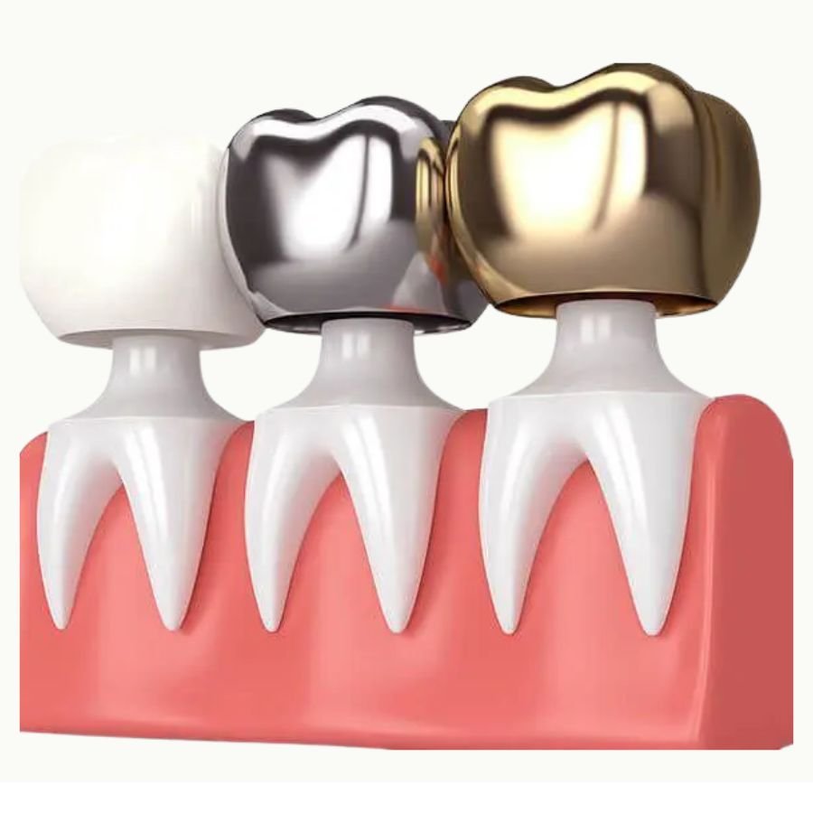 Dental Crown dentist Langley