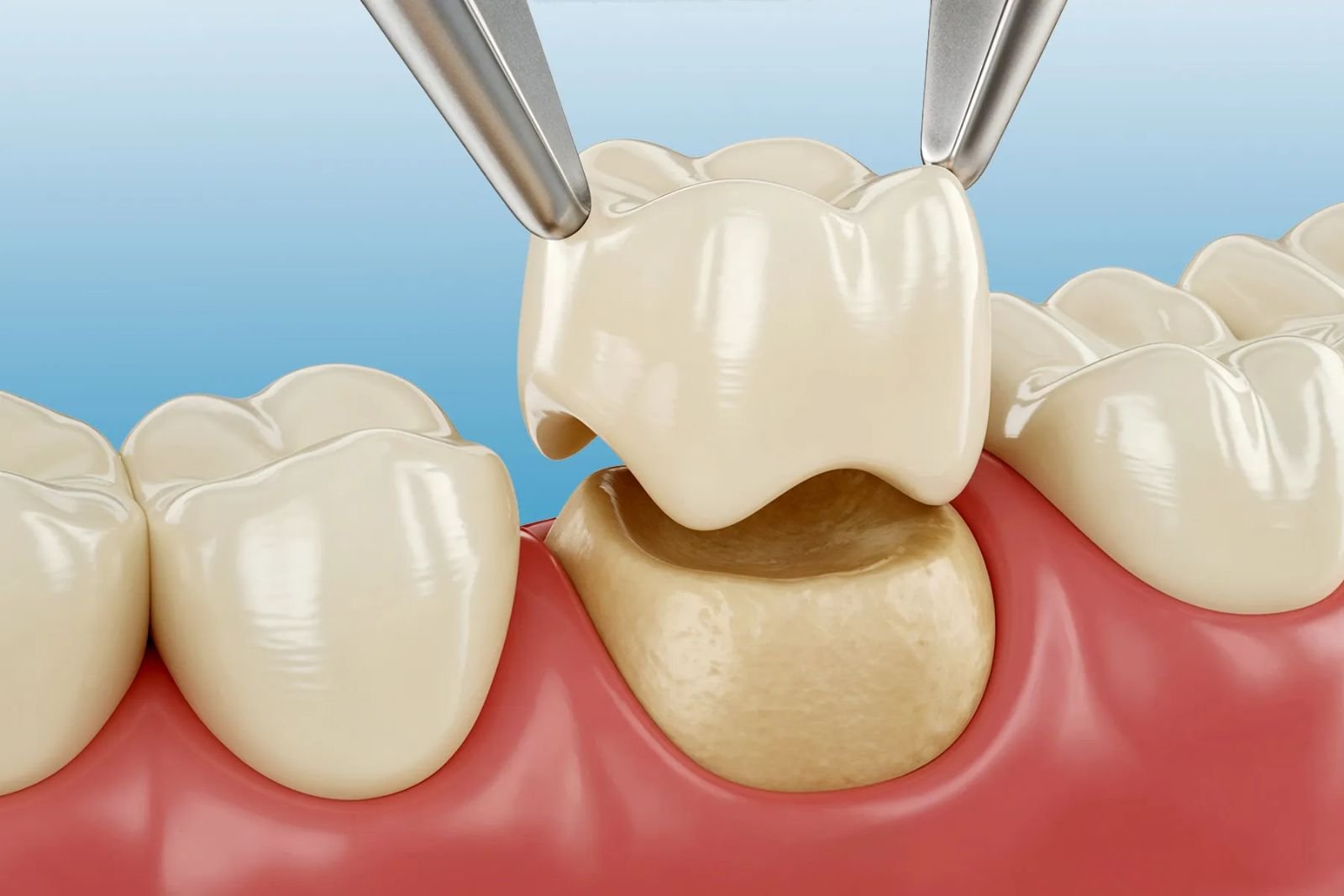 Dental Crowns dentist Slough