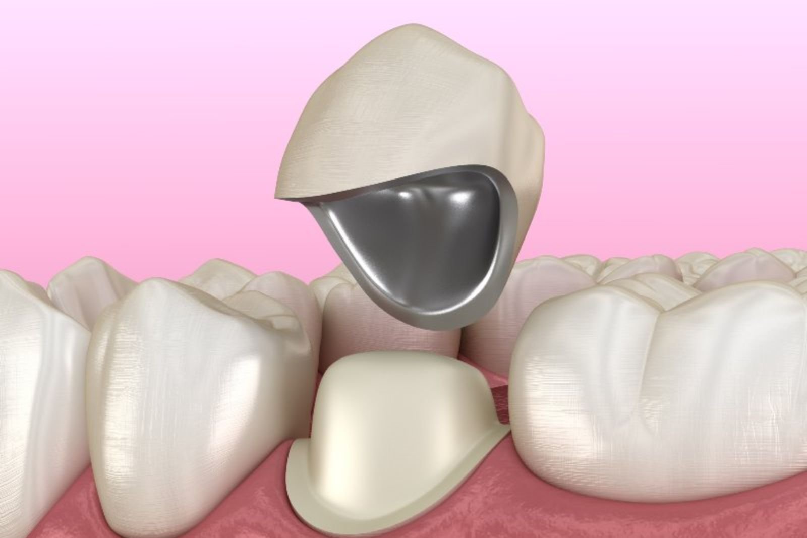 Dental Crowns in Langley
