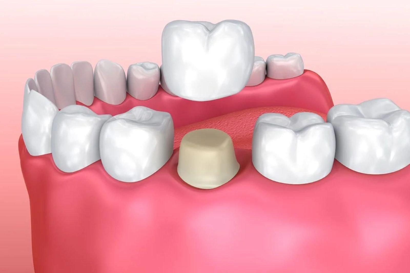 Dental Crowns in Slough