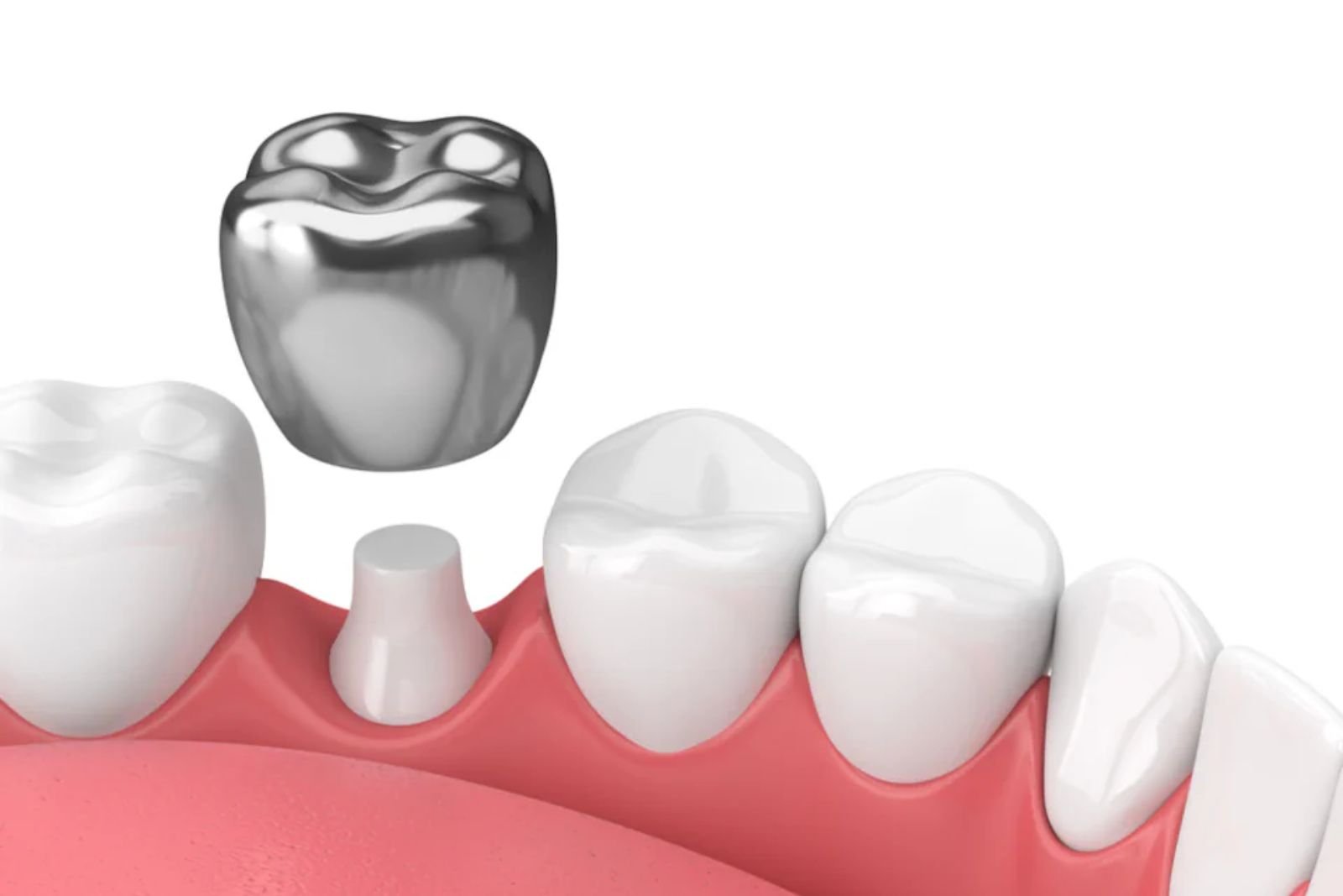 Dental Crowns treatment Langley