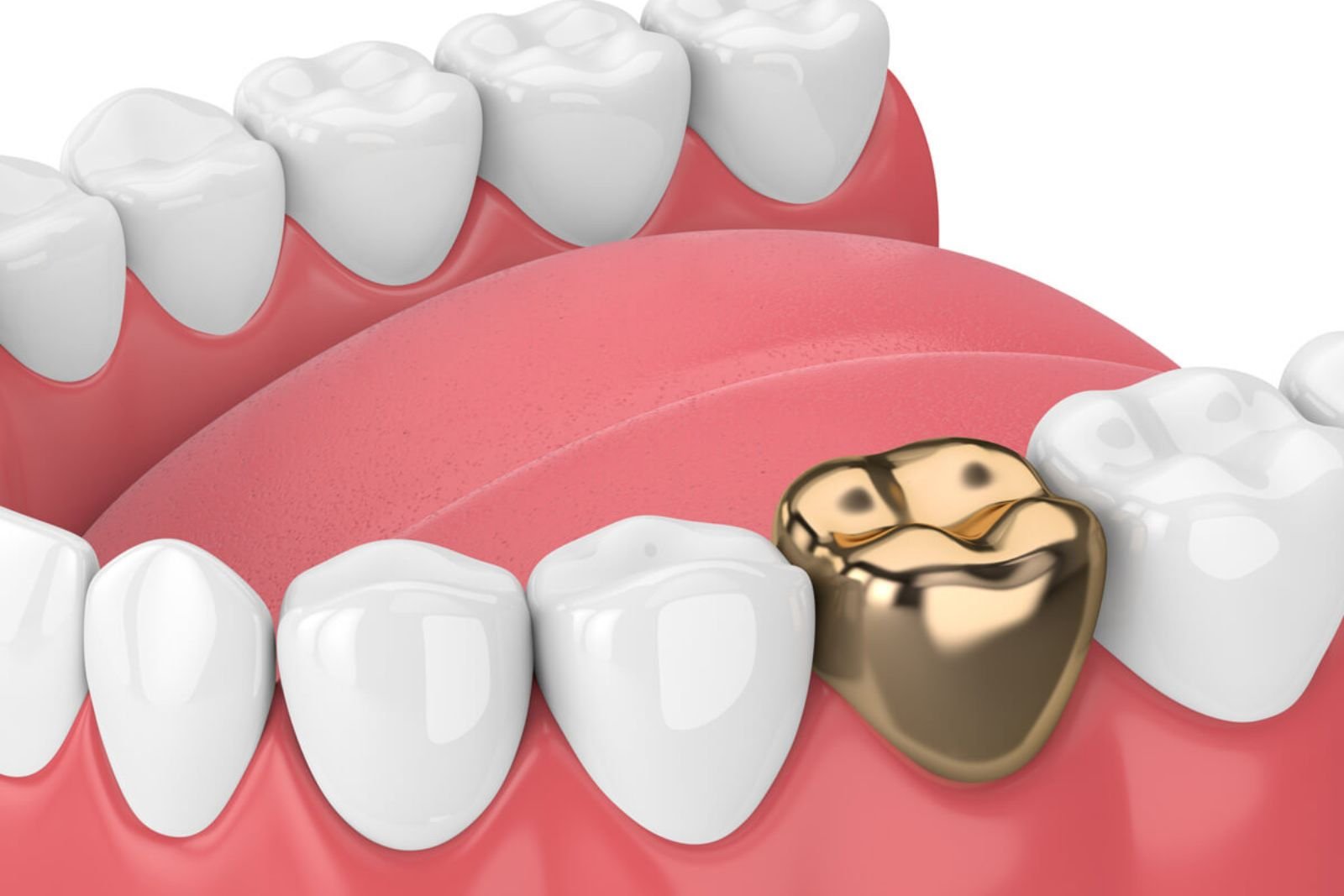 Dental Crowns treatment Slough
