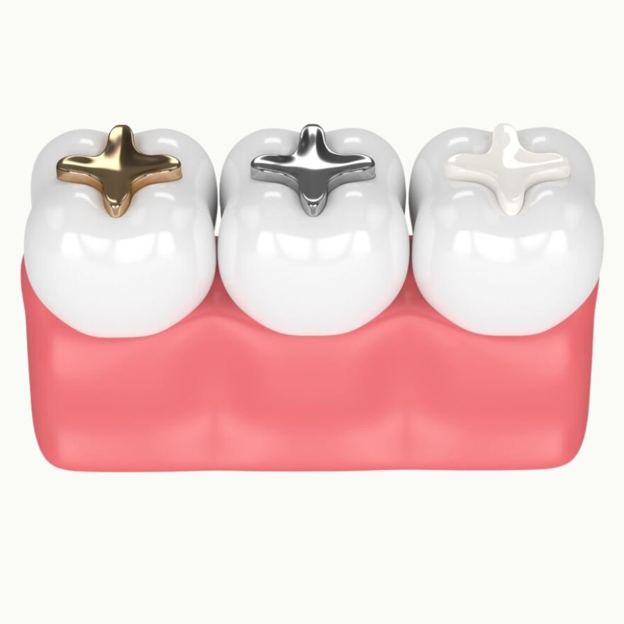Dental Onlay Langley