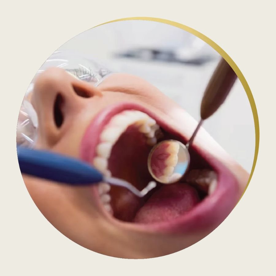 Dental Onlay Slough