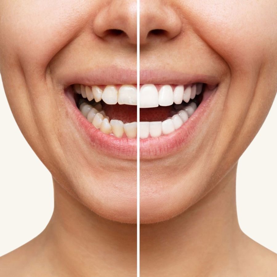 Dental Veneers in Slough