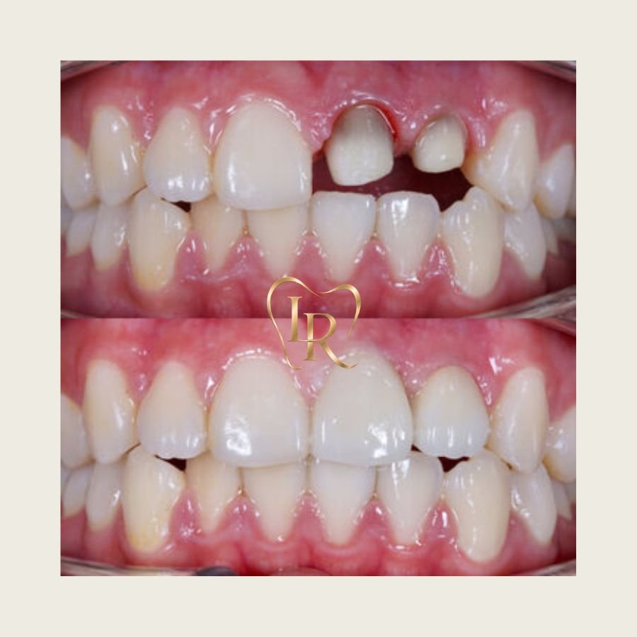 Langley Dental Crown dentist