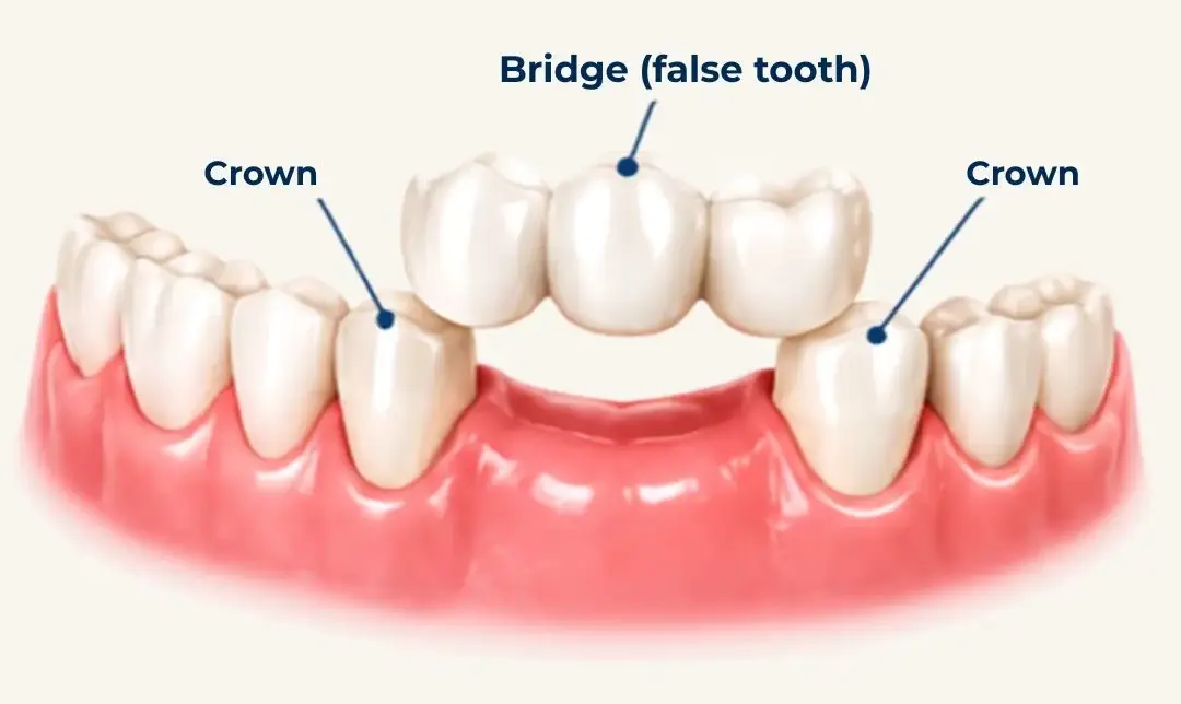 dental bridges treatment Langley