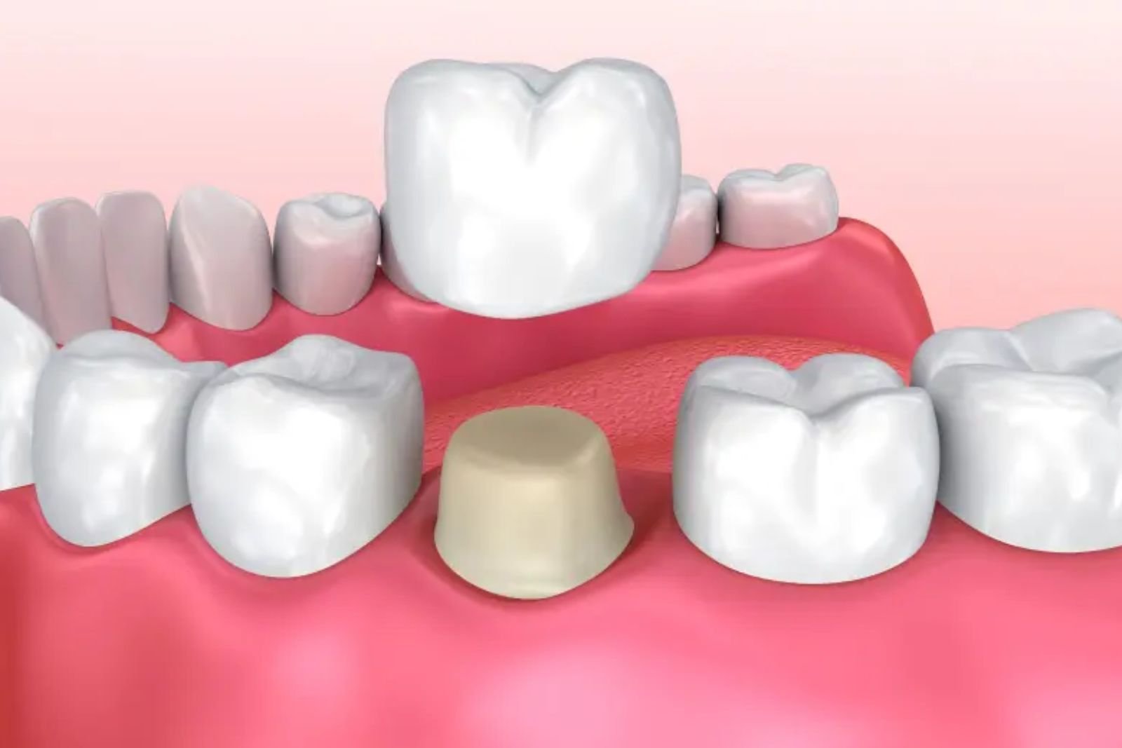Restorative Dentistry in Langley