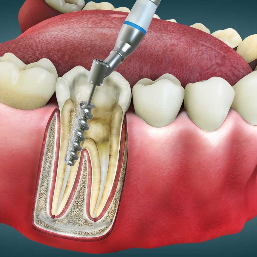 Root Canal Treatment Langley