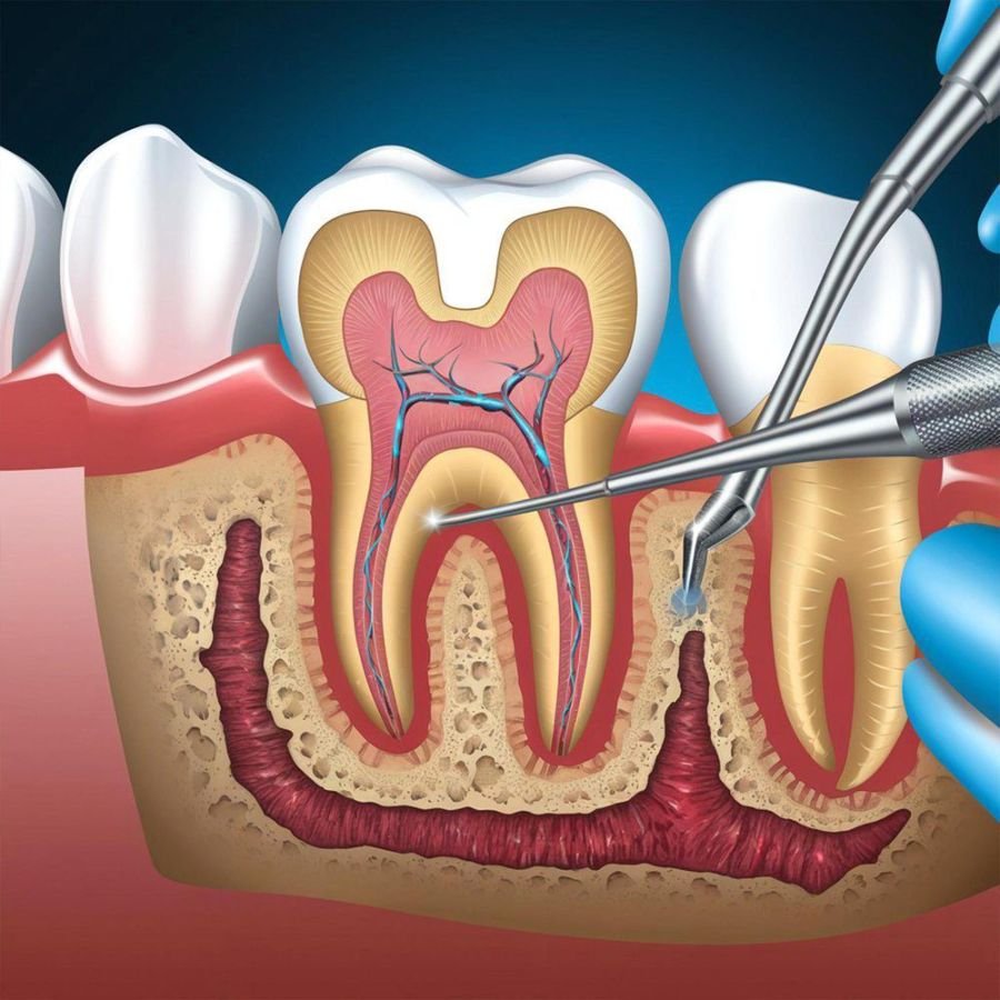Root Canal Treatment Slough