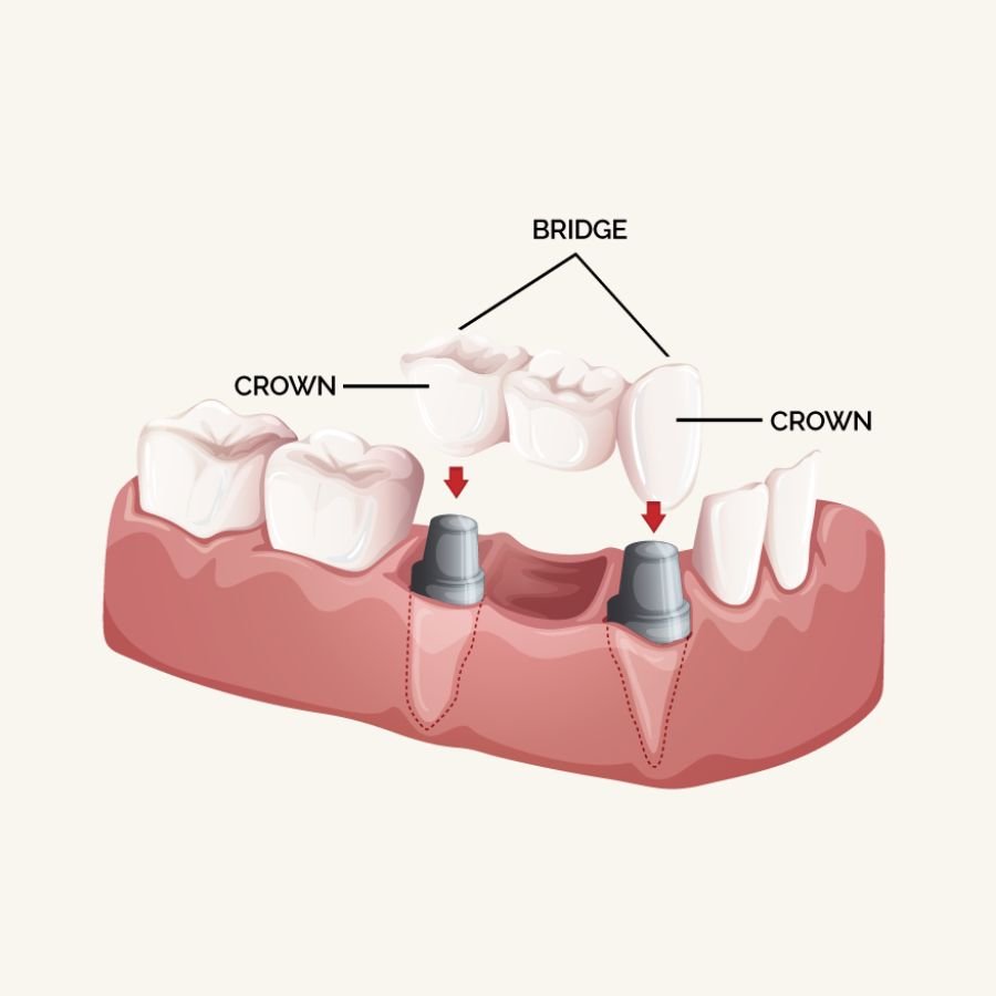 Slough Dental Crown dentist