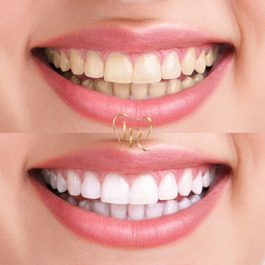 Slough Teeth whitening
