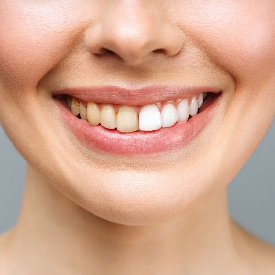 Teeth whitening in Slough