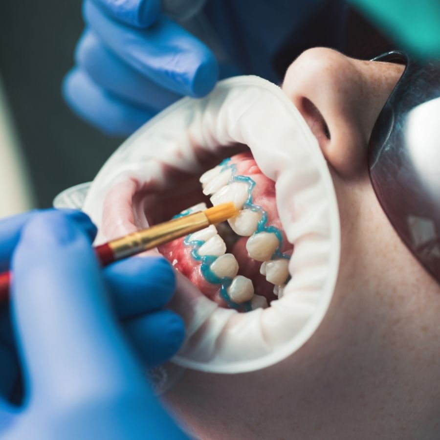 Teeth whitening treatment Slough