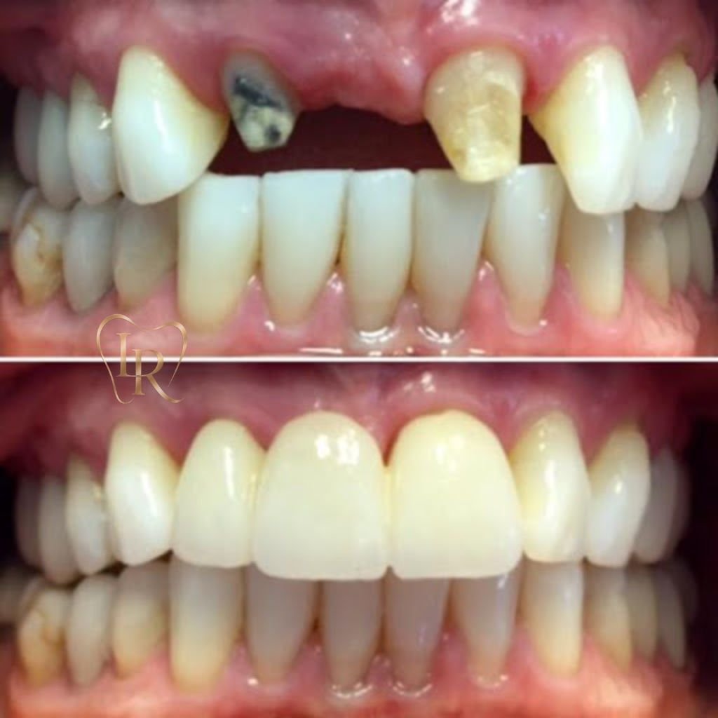 best bridges dentist in Slough
