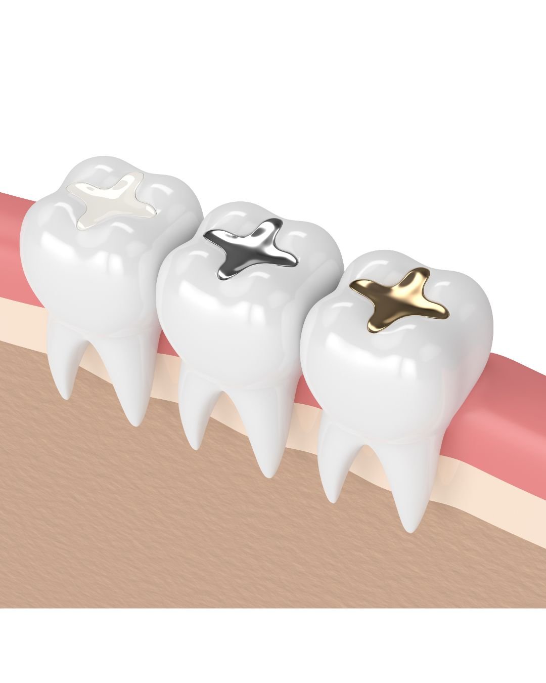 best filling dentist in Langley