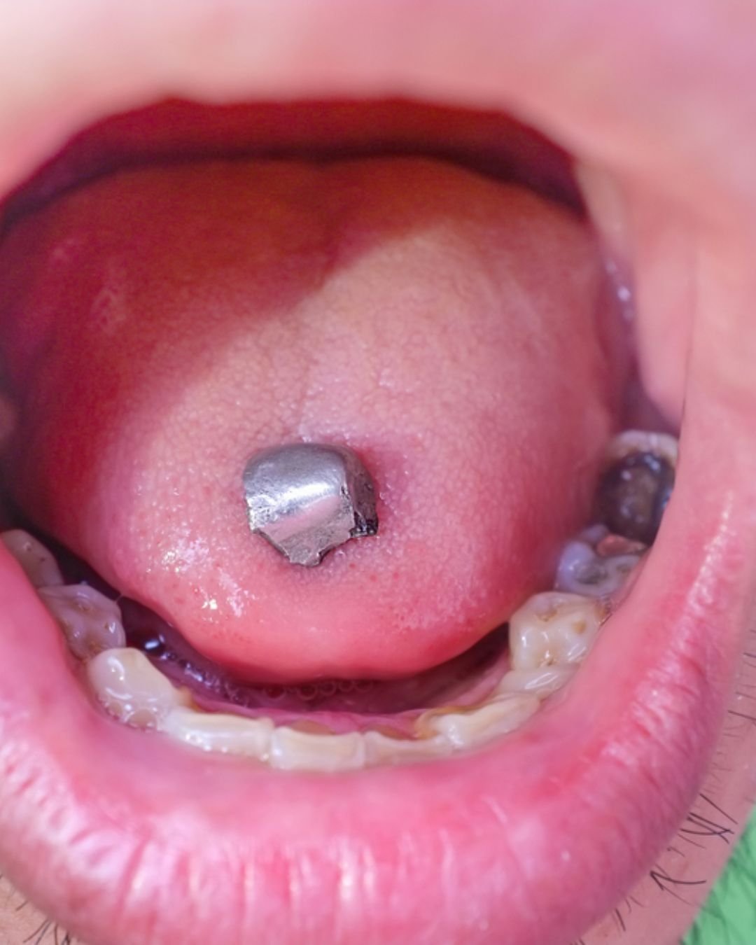 best fillings dentist in Langley