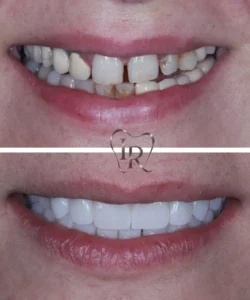 composite bonding before after dentist Langley