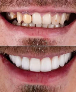 cosmetic dentistry before after Langley