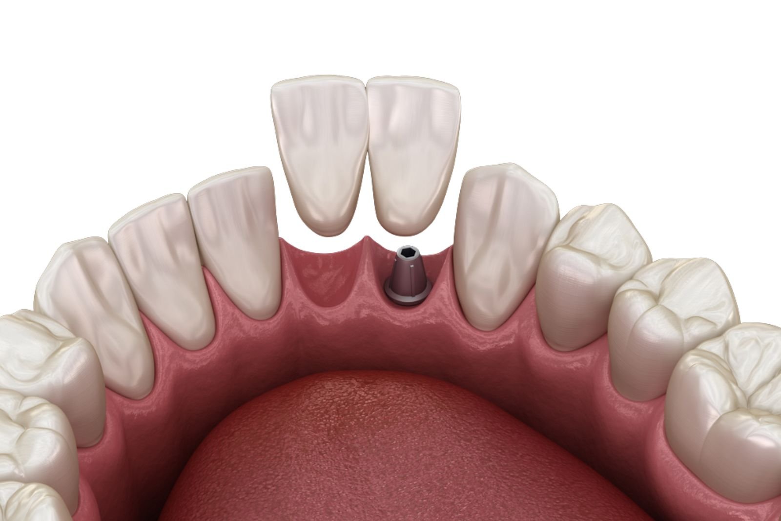 dental bridges dentist Langley