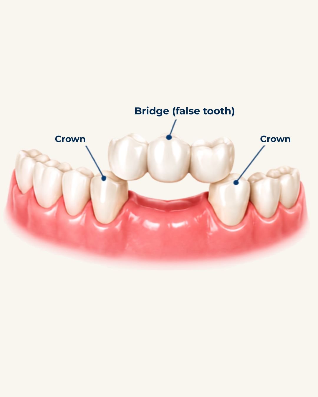 dental bridges treatment Langley