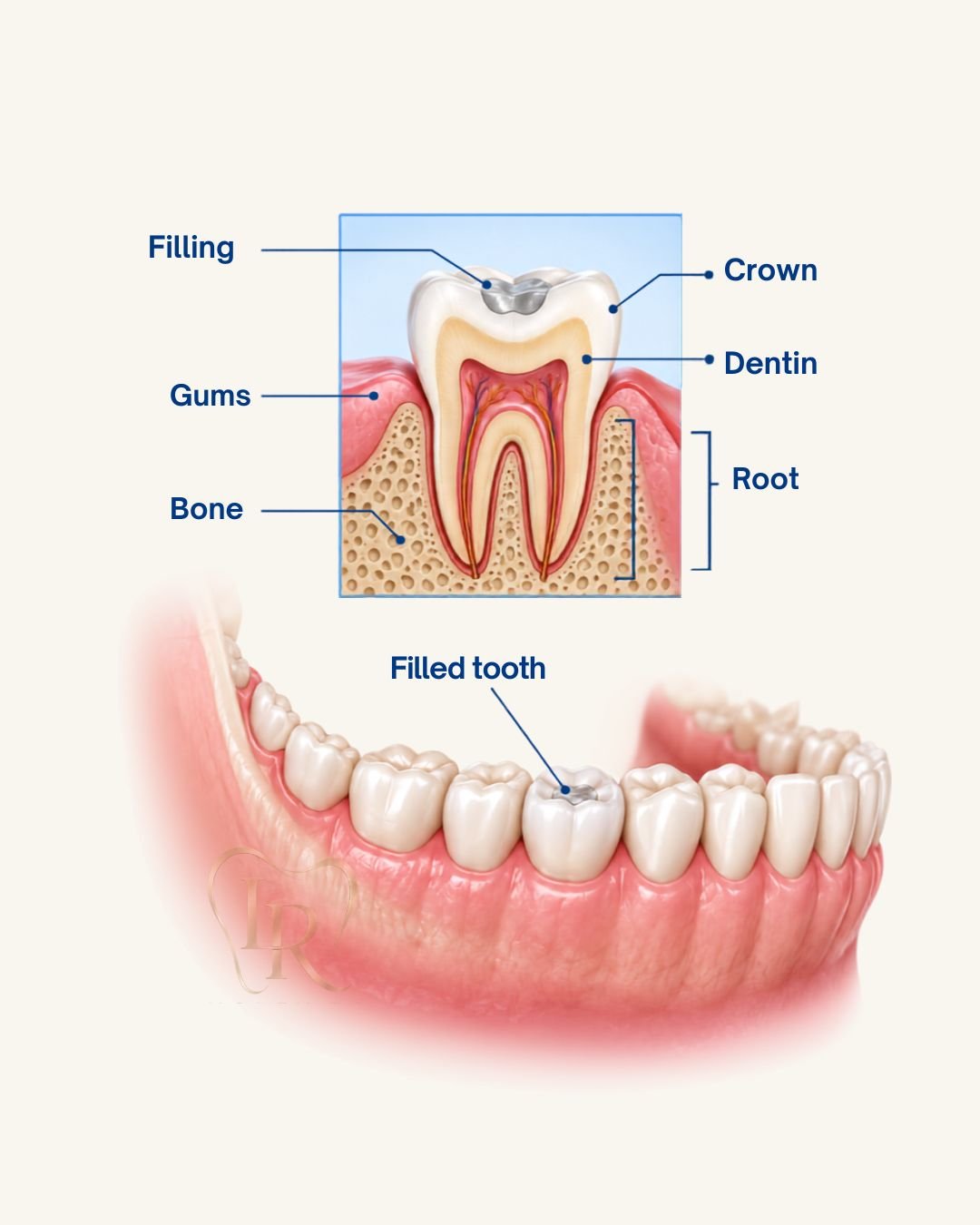 dental fillings treatment Langley