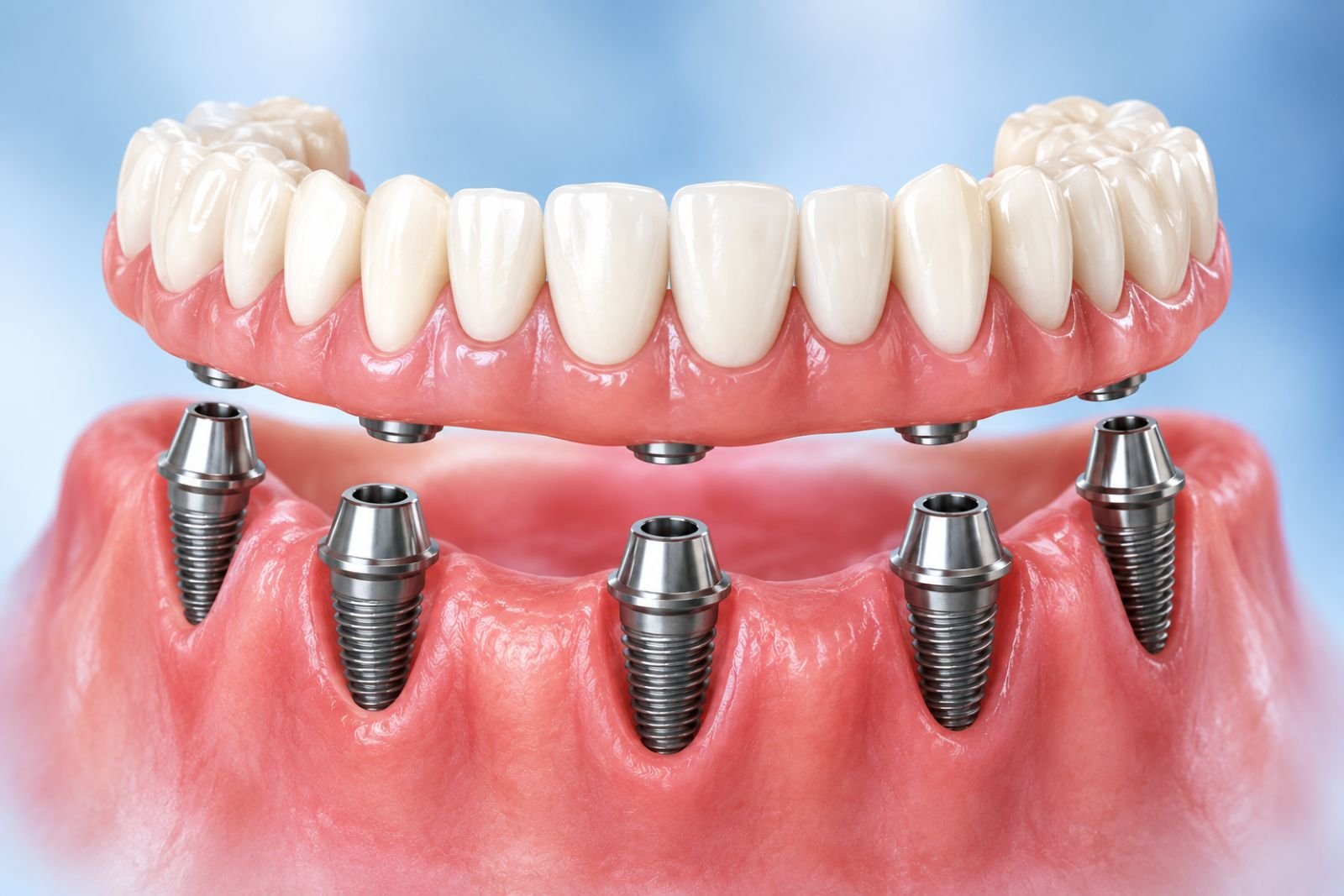 dental implant dentist Langley