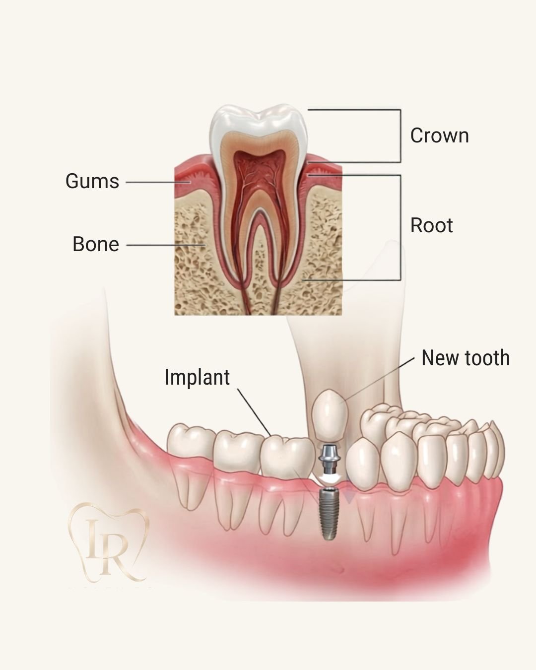 dental implant treatment Langley
