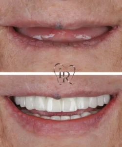 dental implants before after Langley dentist
