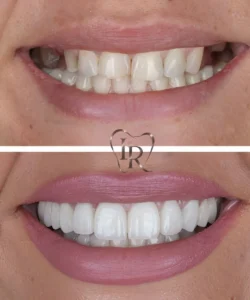 dental implants before after dentist Langley