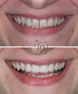 extractions before after dentist Langley