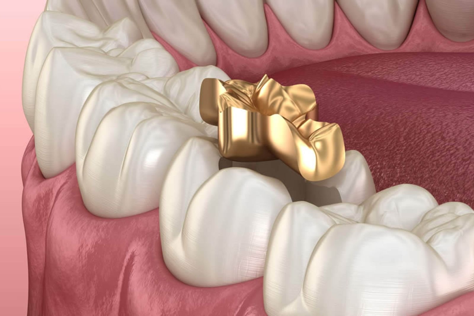 fillings Langley