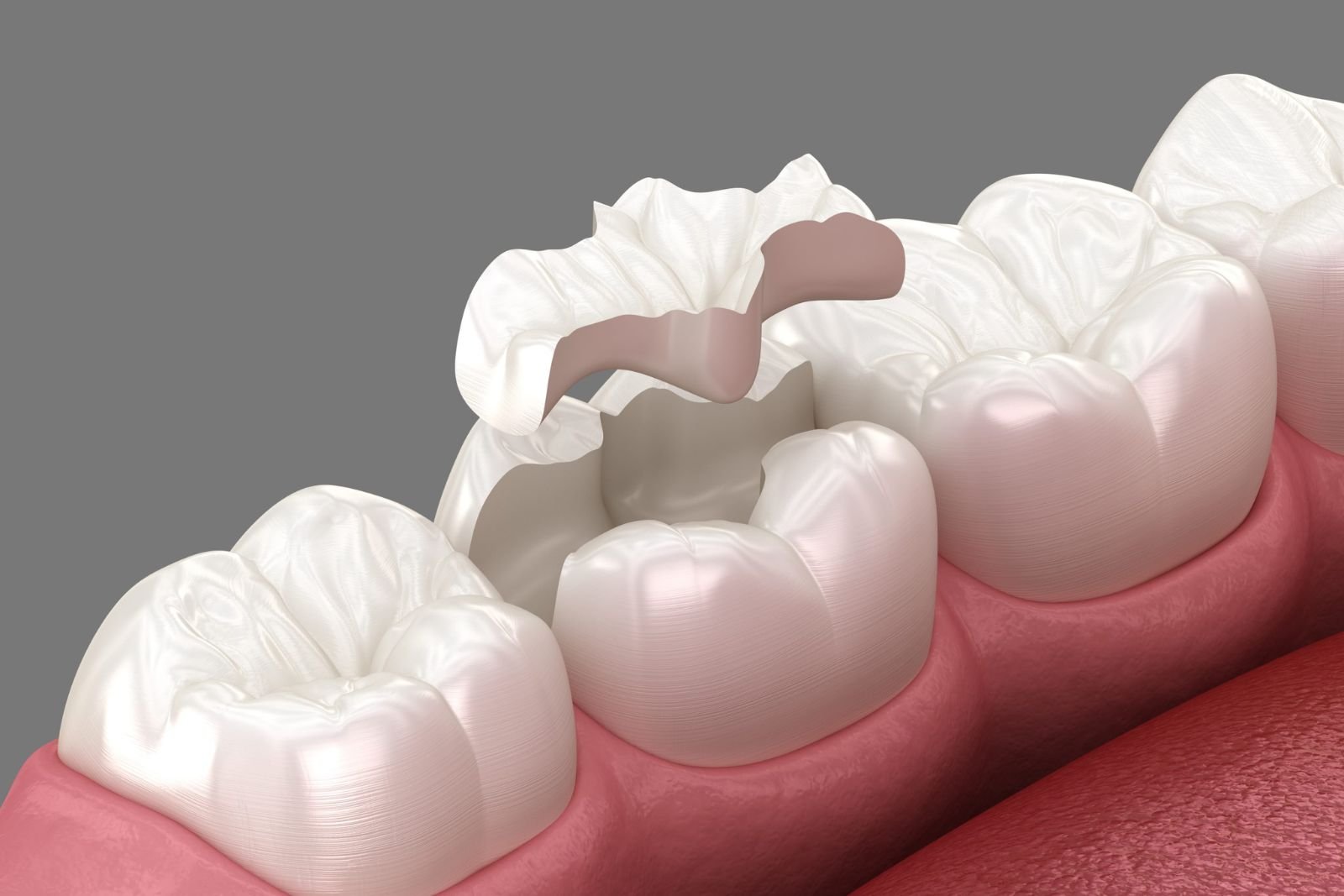 fillings in Langley