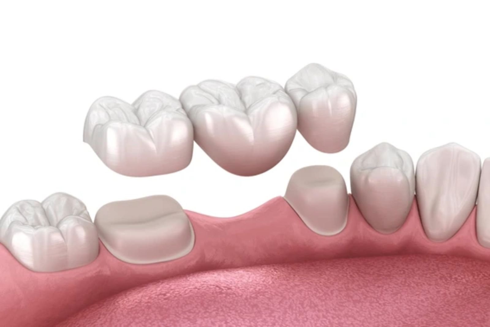 implant bridges Langley