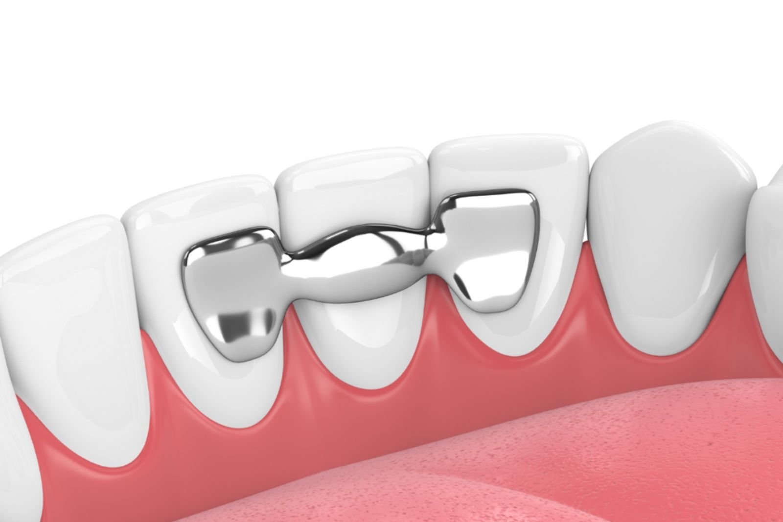 implant bridges Slough