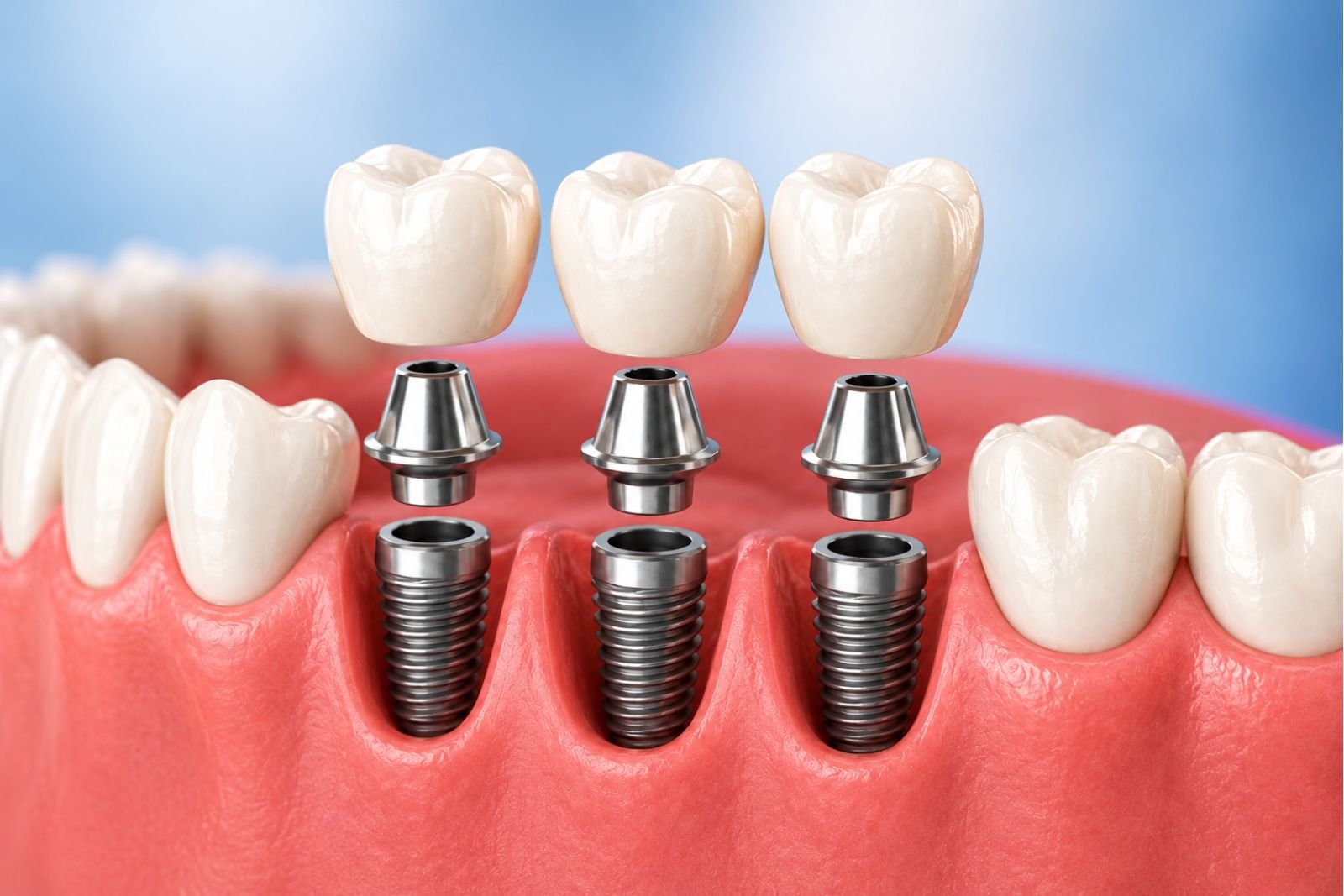 implant dentist Slough