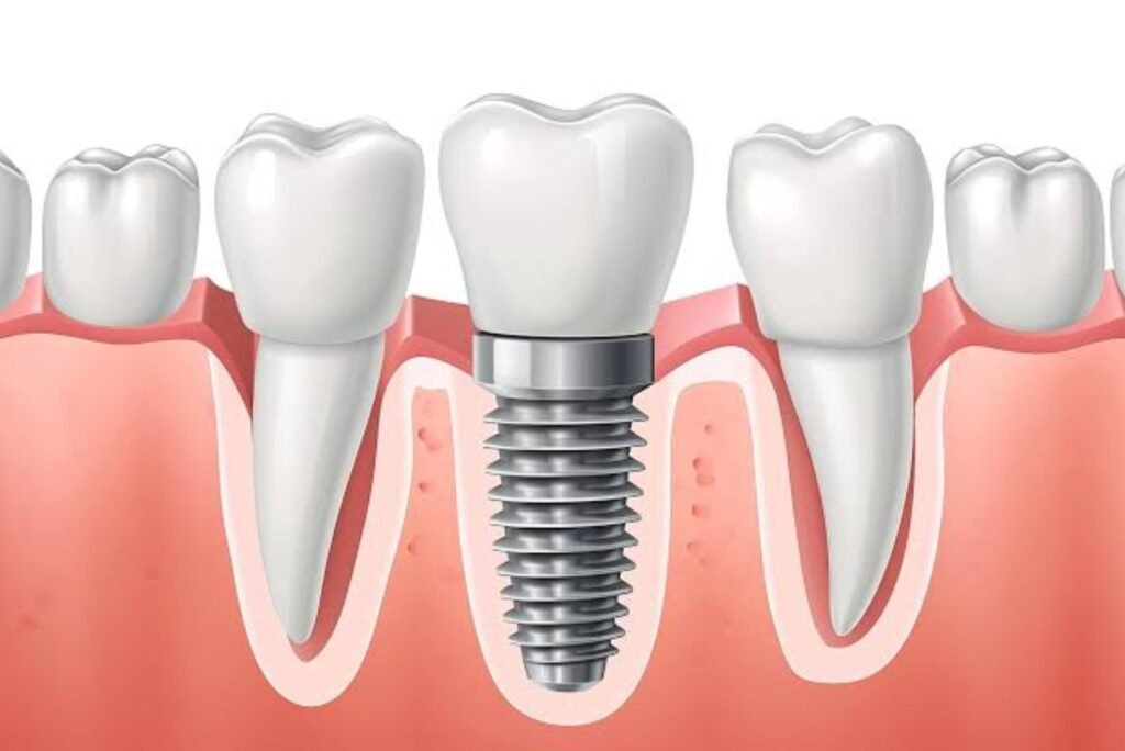 implants dentist Langley