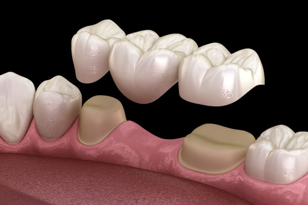 implants dentist in Langley