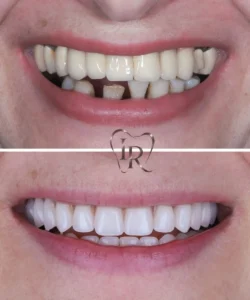 invisalign before after dentist Langley