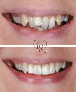 smile makeover before after dentist Langley