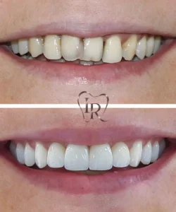 teeth whitening before after Langley dentist