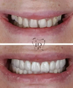 teeth whitening before after dentist Langley