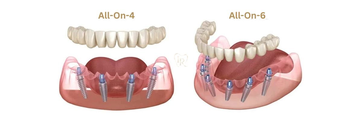 how long does dental implants last