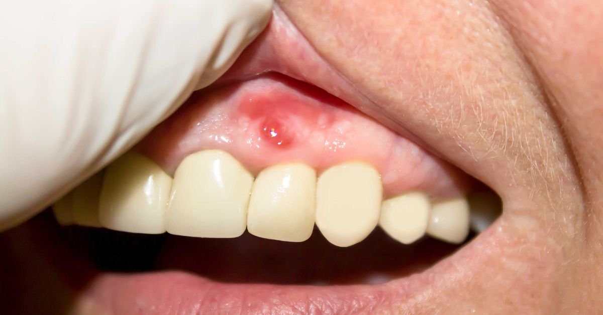 root canal pain symptoms