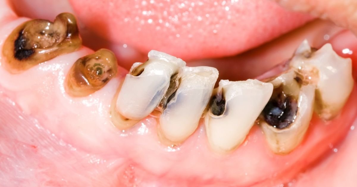tooth pain